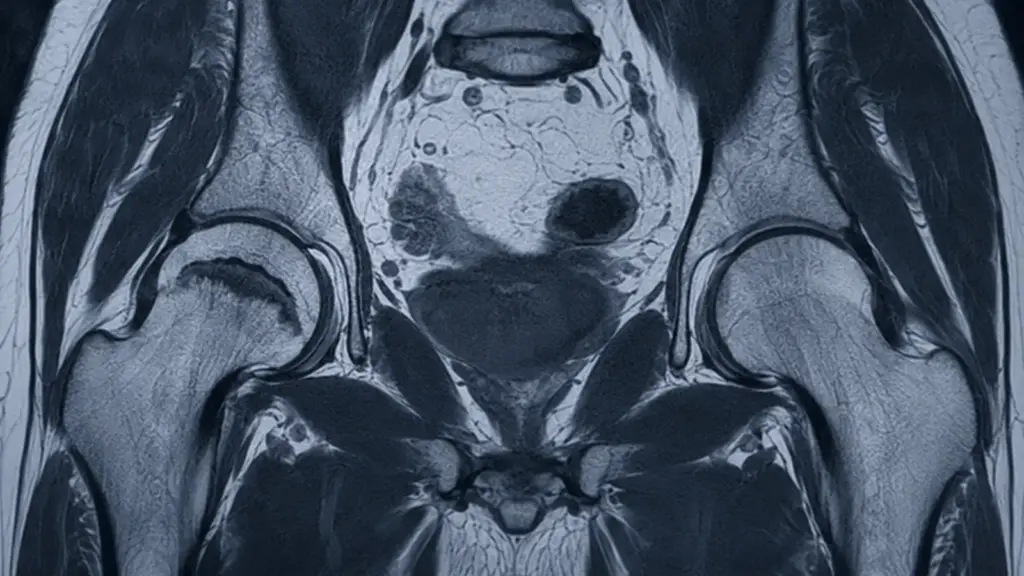 Avascular Necrosis