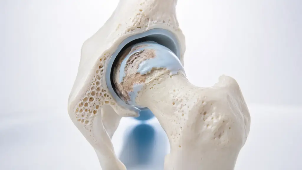 Hip Osteoarthritis (Coxarthrosis)