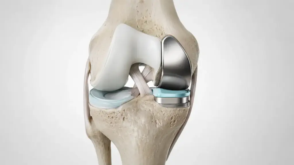 Partial Knee Replacement