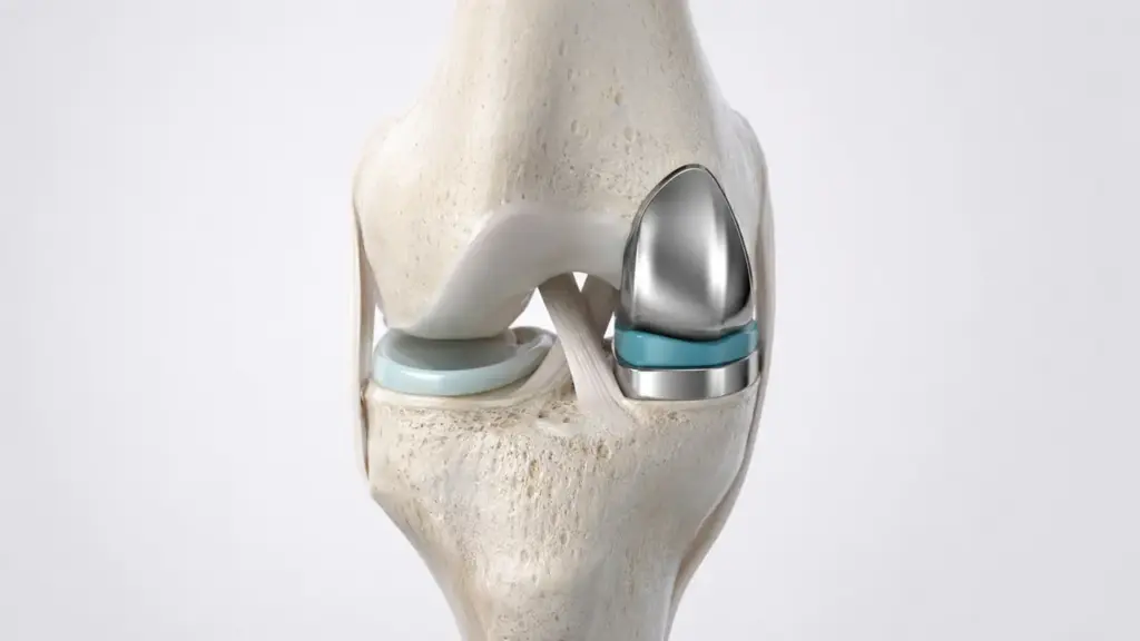 Unicondylar Knee Replacement Surgery